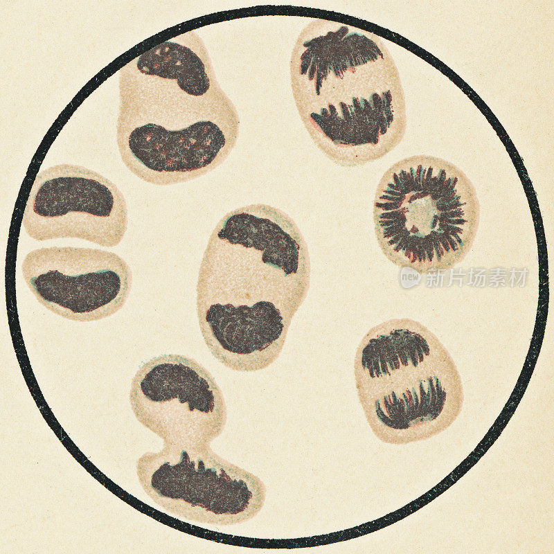 骨髓细胞有丝分裂的人白细胞从慢性髓性白血病患者- 19世纪显微镜观察